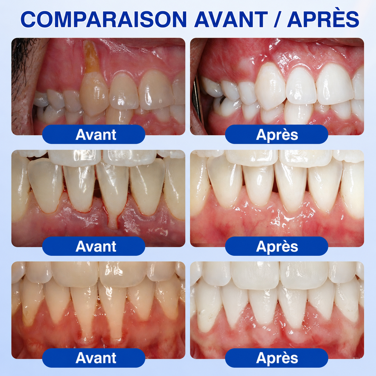 🏅🦷🛡️DOCTIA® GumRevive – Gel Réparateur Parodontal pour Gencives Sensibles🍃🍃